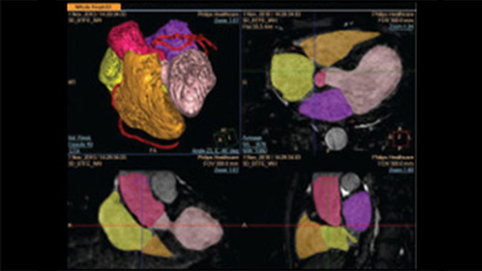 3D 模式下的心脏详细扫描影像