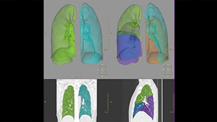 人体肺部的放射扫描影像