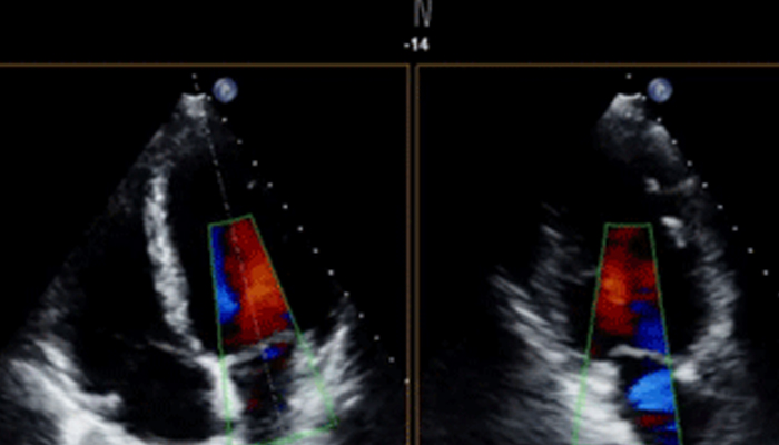 Challenges in 2D and 3D Echo Today