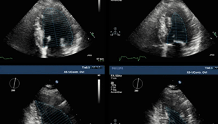 Asymptomatic Aortic Stenosis