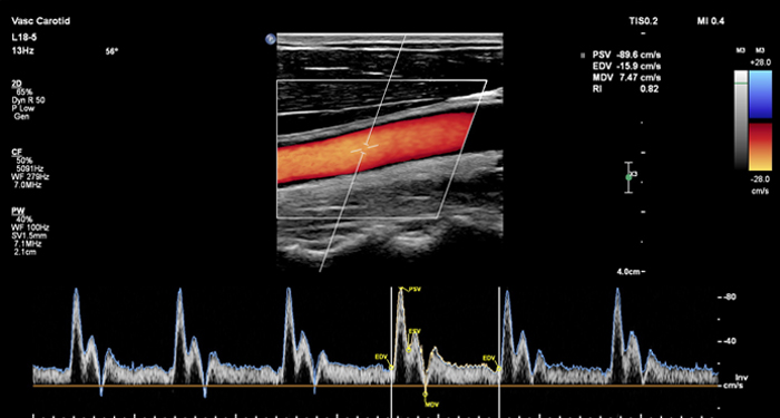 L18-5 Carotid Dop MaxVue