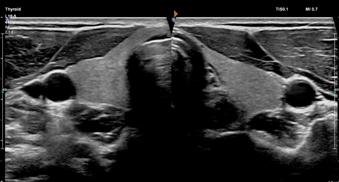 L18-5 Dual Thyroid MaxVue