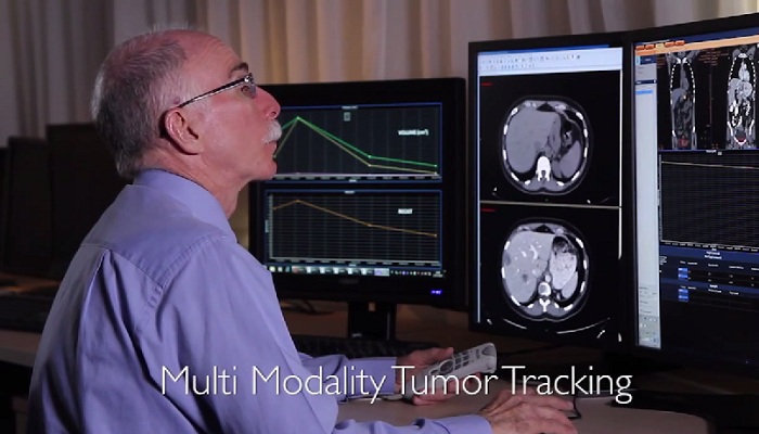 IntelliSpace Portal 星云高级可视化中心上的多模态肿瘤追踪（以色列 Tel Ha -Shomer 的 Sheba 医疗中心）