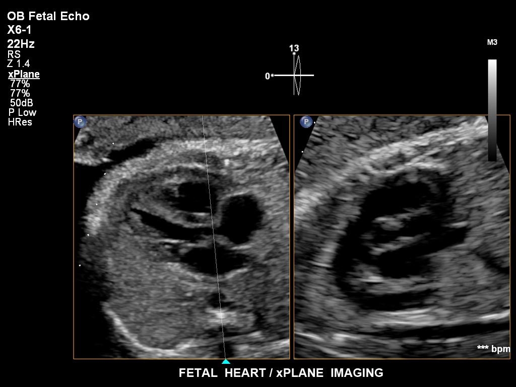 胎儿心脏 / 任意多平面成像