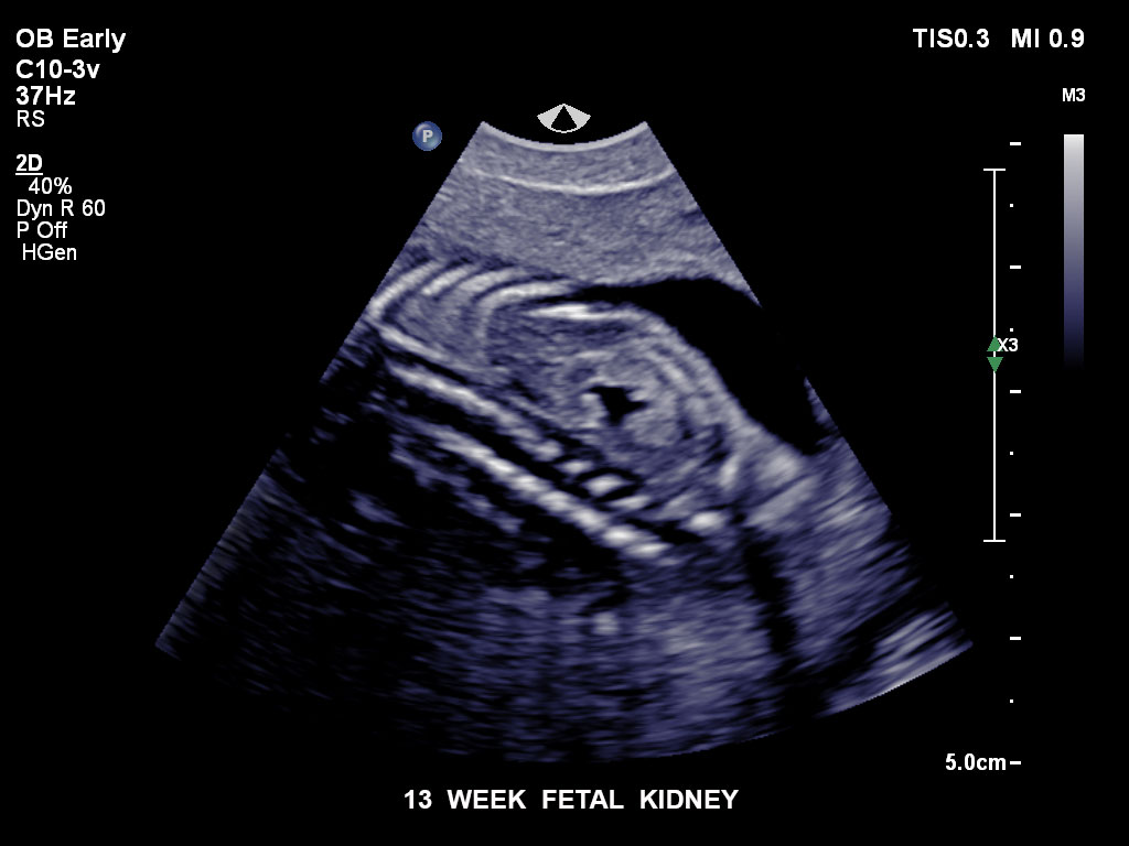 13 周胎儿肾脏